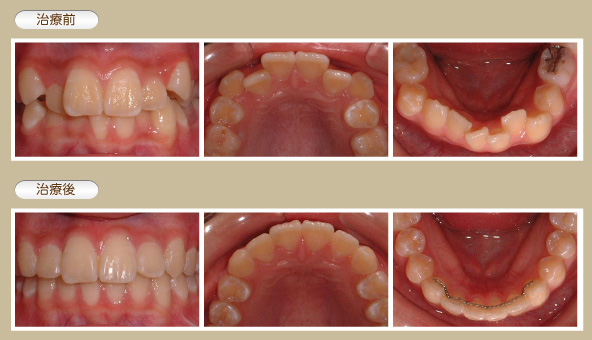 小学生の矯正治療例2