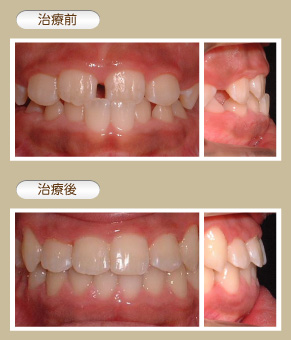 小学生の矯正治療例4