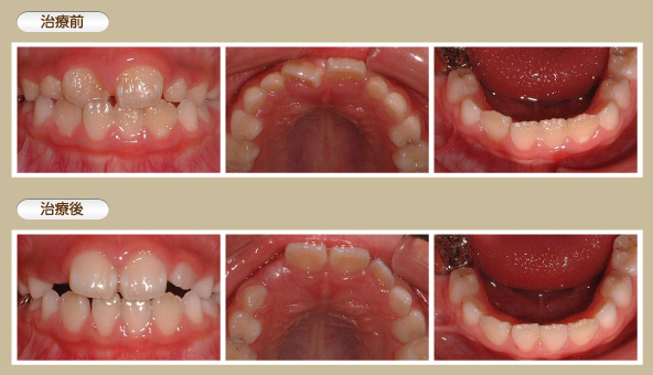 小学生の矯正治療例6