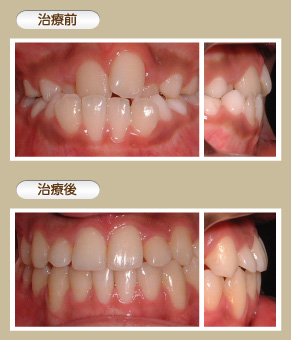 中学生以降の矯正治療例2
