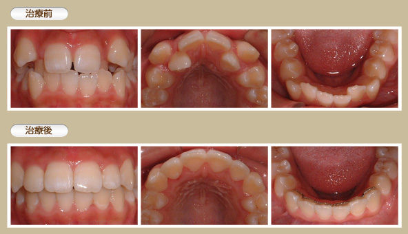 中学生以降の矯正治療例3